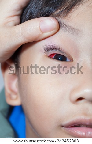 Closeup of pinkeye (conjunctivitis) infection on a little asian (thai) boy, doctor check up eye patient. Studio shot