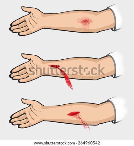 Bleeding. Types of bleeding. Classification. classification of bleeding: capillary, venous, arterial