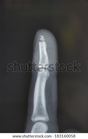 X-ray showing broken finger