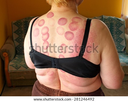 Dark red circle spots on woman`s back skin after medical cupping massage.
