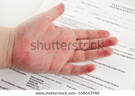 A red rash on a hand over top paperwork at the hospital