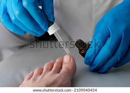 The doctor drips medicine from a pipette onto a sore finger. Close-up of a foot with nail fungus. Onycholysis: detachment of the nail from the nail bed. Foto d'archivio © 
