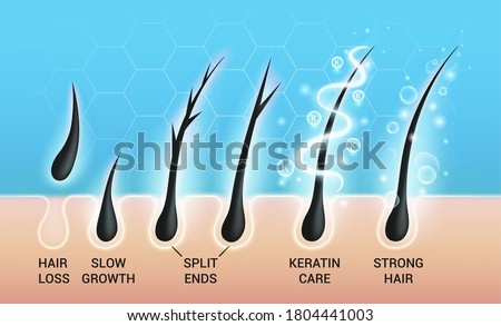Different hair problems and deep salon treatment vector illustrations set, macro view of balding scalp skin and follicles.