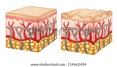 Diagram Showing Normal Skin Tissue And Skin Tissue With Cellulite Stock ...