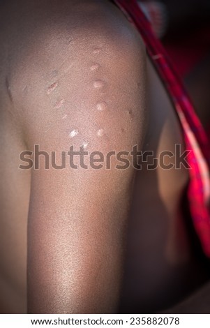 Maasai scars