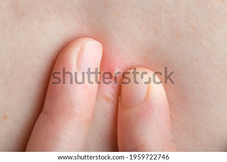 fingers squeeze an inflamed pimple with pus on the human body close-up, faceless person is about to squeeze out acne dermatological theme. Imagine de stoc © 