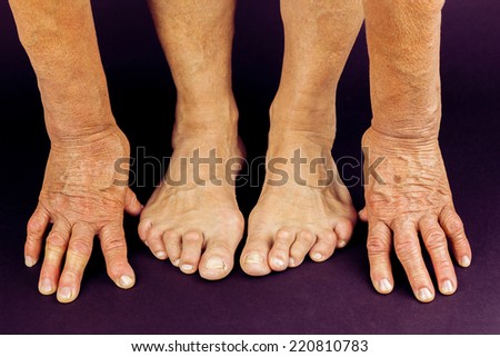 Rheumatoid arthritis hand and toe deformities. Macro