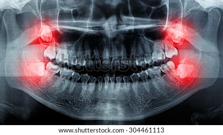 film X-Ray scan human for tooth Impaction