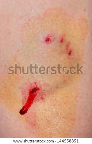 Disinfected sore and skin after dog bite, puncture wound