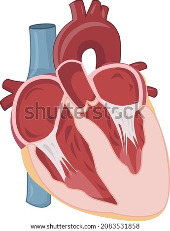 left ventricular hypertrophy due to hypertension illustration