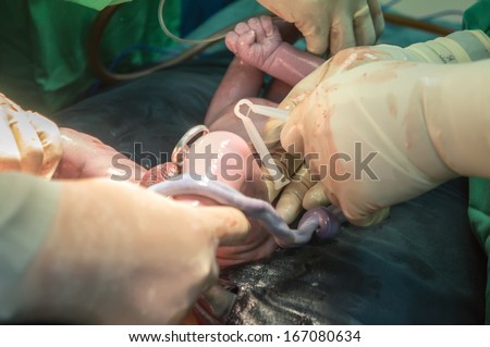 Operation for cesarean section with new born infant in operating theater.