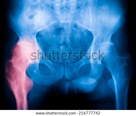 hips x-ray