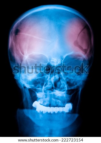 X-ray of the skull after brain surgery / ventriculoperitoneal drainage