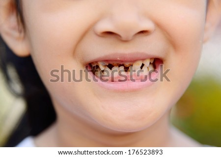 decayed tooth in young girl