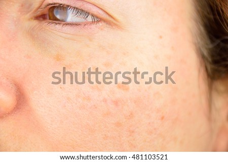 closeup of a woman cheek with liver spot causes by the large exposition sun  ストックフォト © 