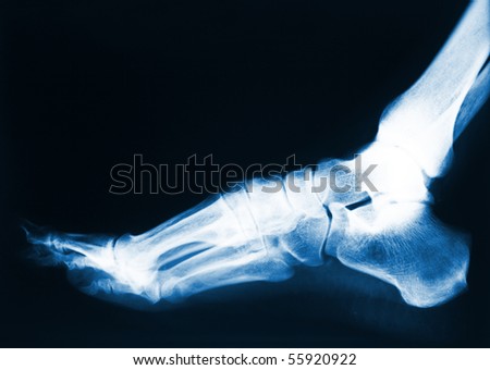 x-ray image of human foot