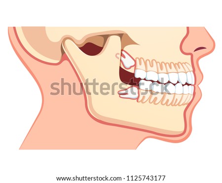 Human jaws model with teeth row. Impacted upper and lower wisdom tooth pushing adjacent teeth. Wisdom third molar tooth problem. Dentistry and dental surgery concept. Flat vector illustration on white