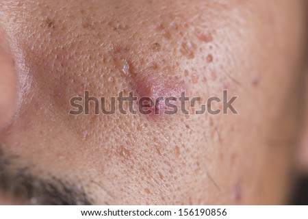 pimple on man skin
