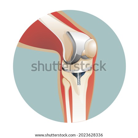 Knee Joint Replacement Surgery - Illustration as EPS 10 File