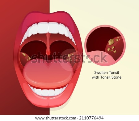 Open Mouth with Sore Throat and Tonsillitis  - stock illustration as EPS 10 File 商業照片 © 