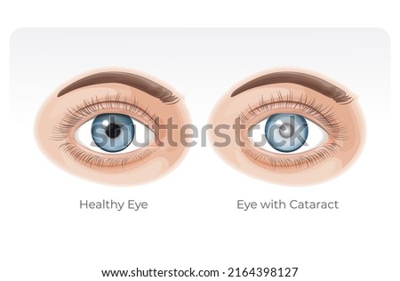 Human Healthy Eye and Eye with Cataract - Illustration as EPS 10 File