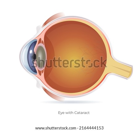 Human Eye with Cataract - Illustration as EPS 10 File