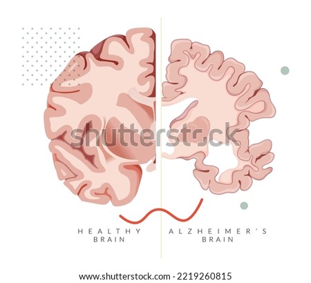 Alzheimer's Disease - Brain Transverse Section Compare with Healthy Brain - Illustration as EPS 10 File