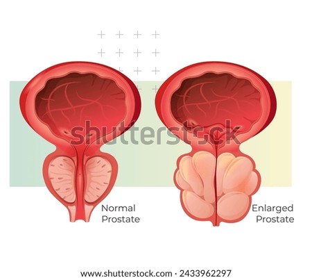 Normal Prostate and Enlarged Prostate Gland under Bladder - Stock Illustration as EPS 10 File