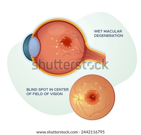 Wet Macular Degeneration - Stock Illustration as EPS 10 File