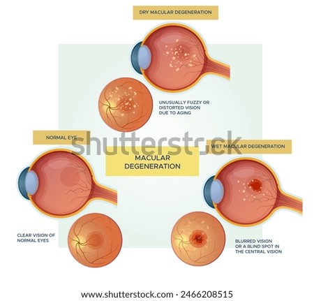 Normal Eyes vs Dry - Wet Macular Degeneration - Stock Illustration as EPS 10 File