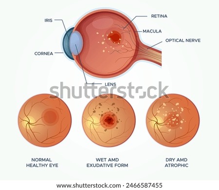 Understanding Macular Degeneration Healthy Eyes vs Wet and DRY AMD - Stock Illustration as EPS 10 File