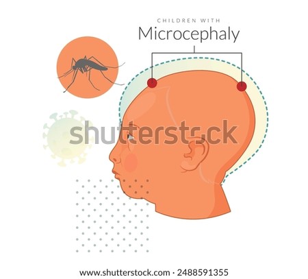 Children with microcephaly - Zika Virus - Stock Illustration as EPS 10 File