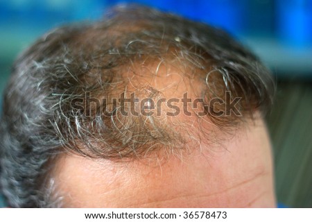 Male Head With Hair Loss Symptoms Front Side Stock Photo 36578473 ...