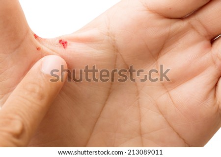 bleeding form corn on palm of hand