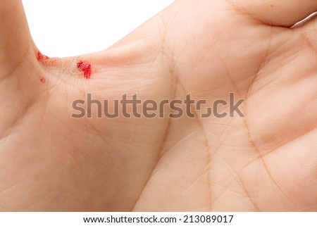 bleeding form corn on palm of hand