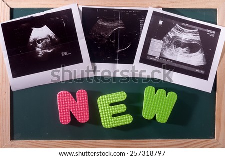 New and ultrasound scan picture, conceptual colourful word and image on blackboard