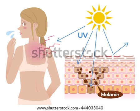 Mechanism Of Sunburn, Young Female With A Bad Sunburn On Her Back Stock ...