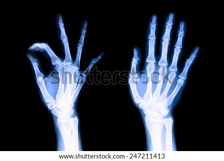 X-ray blue fingers to check for irregularities in the motion of the fingers are not.