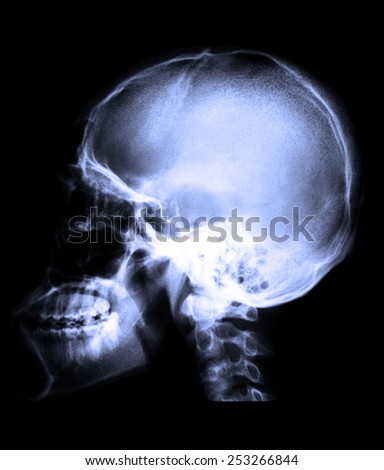 Blue X-ray image of human lateral skull in order to detect abnormalities or damage that occurs to the patientskull.