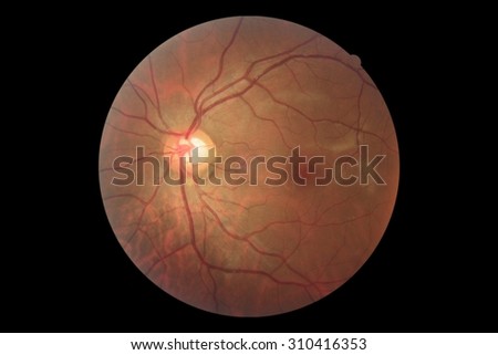 Human eye anatomy, retina, taking images with Mydriatic Retinal cameras