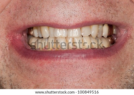 Close up macro shot of interior of mouth and fillings and crowns on teeth