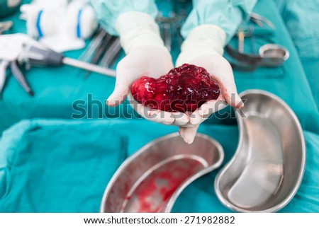 surgeon show lung specimen after surgery