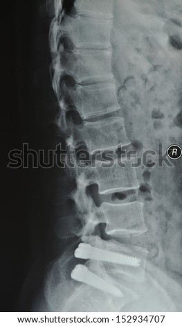 After surgery, lumbar disc prolapse lateral X-ray slice