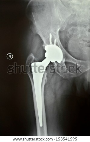 After artificial femoral head replacement surgery, x light slice