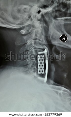 Cervical bone hyperplasia after surgery, X-ray of cervical vertebra side photos