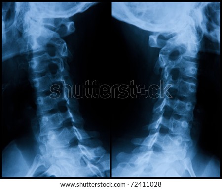 Radiograph of the neck spinal column, left and right high section