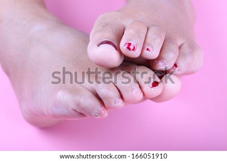 Feet and toes in poor condition/In need of a pedicure/Feet and toes of a woman that are dry, cracked and in need of a pedicure