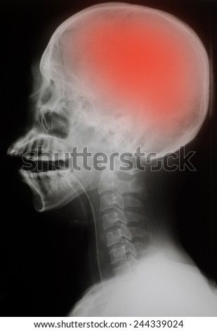 X-ray : Lateral skull - head injury