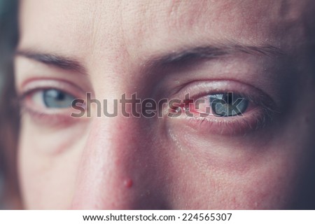 Close up on a woman\'s bloodshot crying eyes