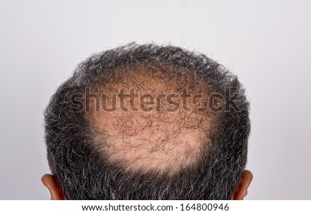 six months after hair transplant surgery